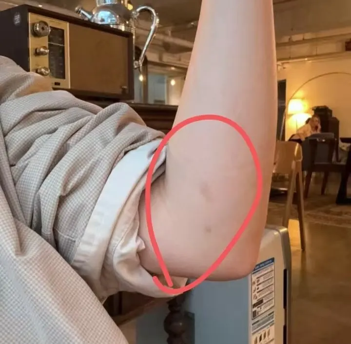 실내에서 팔을 굽혀 기댄 모습의 작업 전 피부 사진. 팔 안쪽 부위에 빨간 원이 그려져 있고, 원 안쪽 피부에 옅은 자국이 보인다.